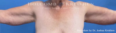Arm Lift Before & After Gallery - Patient 104733 - Image 2