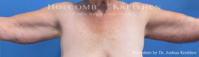 Arm Lift Before & After Gallery - Patient 104733 - Image 2