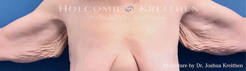Arm Lift Before & After Gallery - Patient 200884 - Image 1