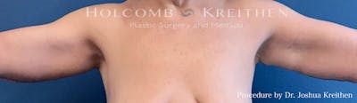 Arm Lift Before & After Gallery - Patient 200884 - Image 2