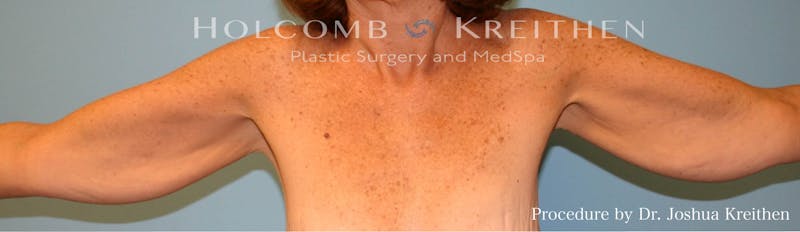 Arm Lift Before & After Gallery - Patient 337531 - Image 1