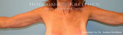 Arm Lift Before & After Gallery - Patient 337531 - Image 2