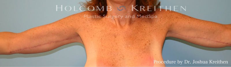 Arm Lift Before & After Gallery - Patient 337531 - Image 2