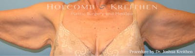 Arm Lift Before & After Gallery - Patient 210596 - Image 1
