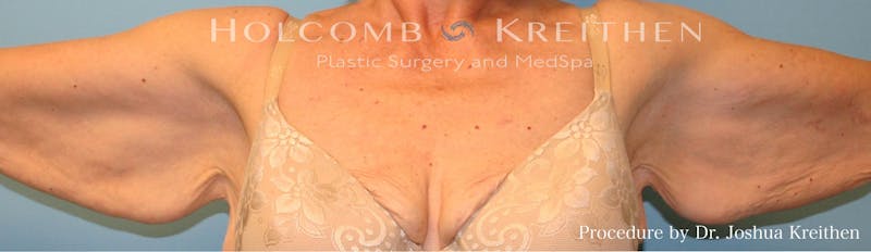Arm Lift Before & After Gallery - Patient 210596 - Image 1
