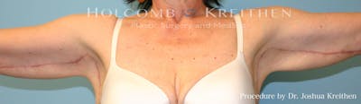 Arm Lift Before & After Gallery - Patient 210596 - Image 2