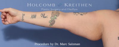 Arm Lift Before & After Gallery - Patient 341006 - Image 1