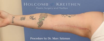 Arm Lift Before & After Gallery - Patient 341006 - Image 2