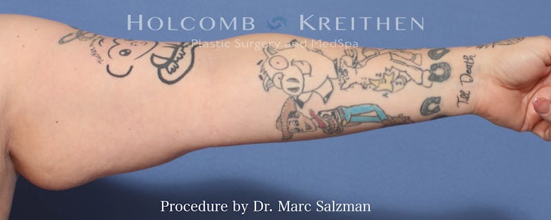 Arm Lift Before & After Gallery - Patient 341006 - Image 3