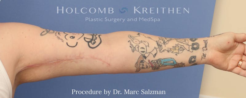 Arm Lift Before & After Gallery - Patient 341006 - Image 4
