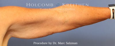 Arm Lift Before & After Gallery - Patient 782766 - Image 1