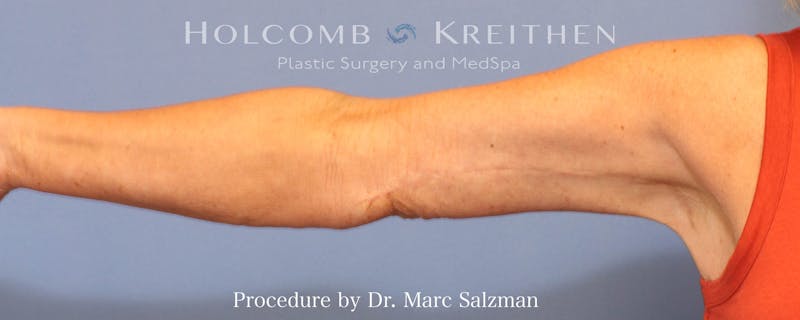 Arm Lift Before & After Gallery - Patient 782766 - Image 4