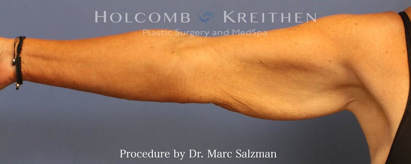 Arm Lift Before & After Gallery - Patient 782766 - Image 3