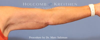 Arm Lift Before & After Gallery - Patient 782766 - Image 2