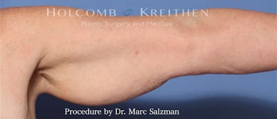 Arm Lift Before & After Gallery - Patient 854663 - Image 1