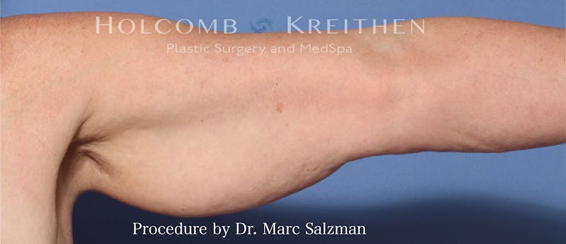 Arm Lift Before & After Gallery - Patient 854663 - Image 1
