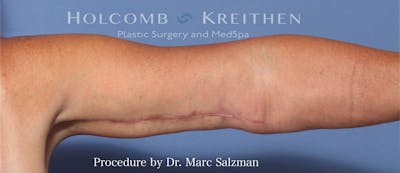 Arm Lift Before & After Gallery - Patient 854663 - Image 2