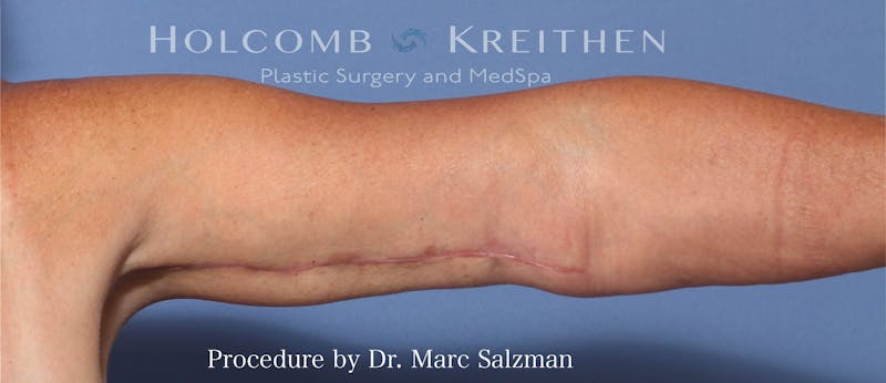 Arm Lift Before & After Gallery - Patient 854663 - Image 2