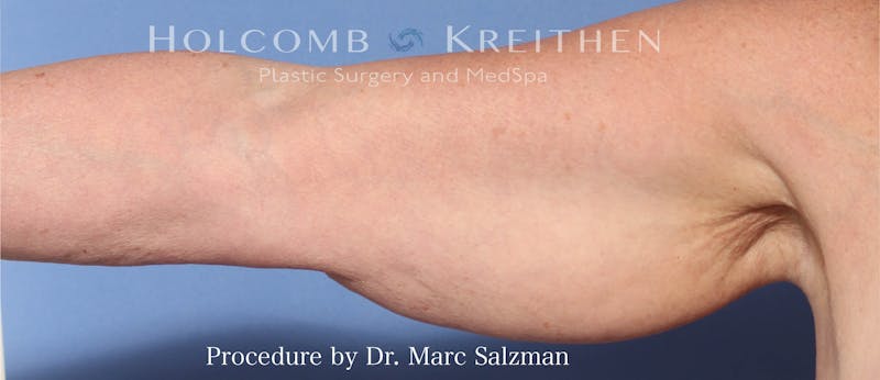 Arm Lift Before & After Gallery - Patient 854663 - Image 3