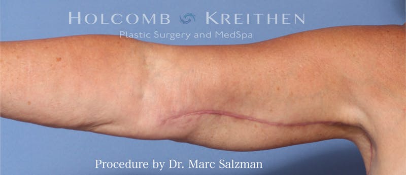 Arm Lift Before & After Gallery - Patient 854663 - Image 4