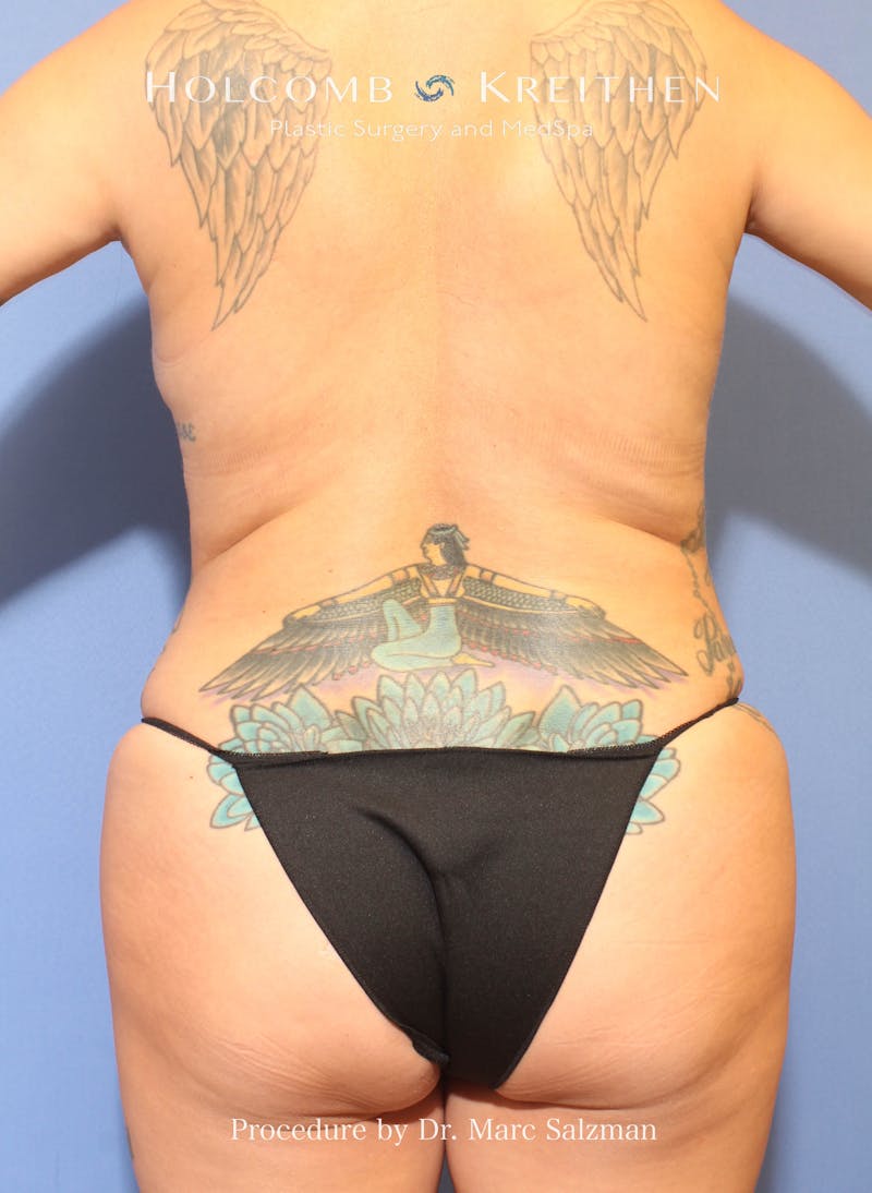 Brazilian Butt Lift Before & After Gallery - Patient 270512 - Image 1