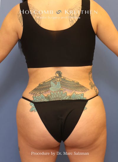 Brazilian Butt Lift Before & After Gallery - Patient 270512 - Image 2