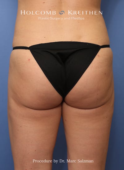 Brazilian Butt Lift Before & After Gallery - Patient 311142 - Image 2
