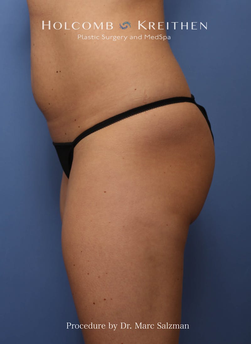 Brazilian Butt Lift Before & After Gallery - Patient 311142 - Image 5