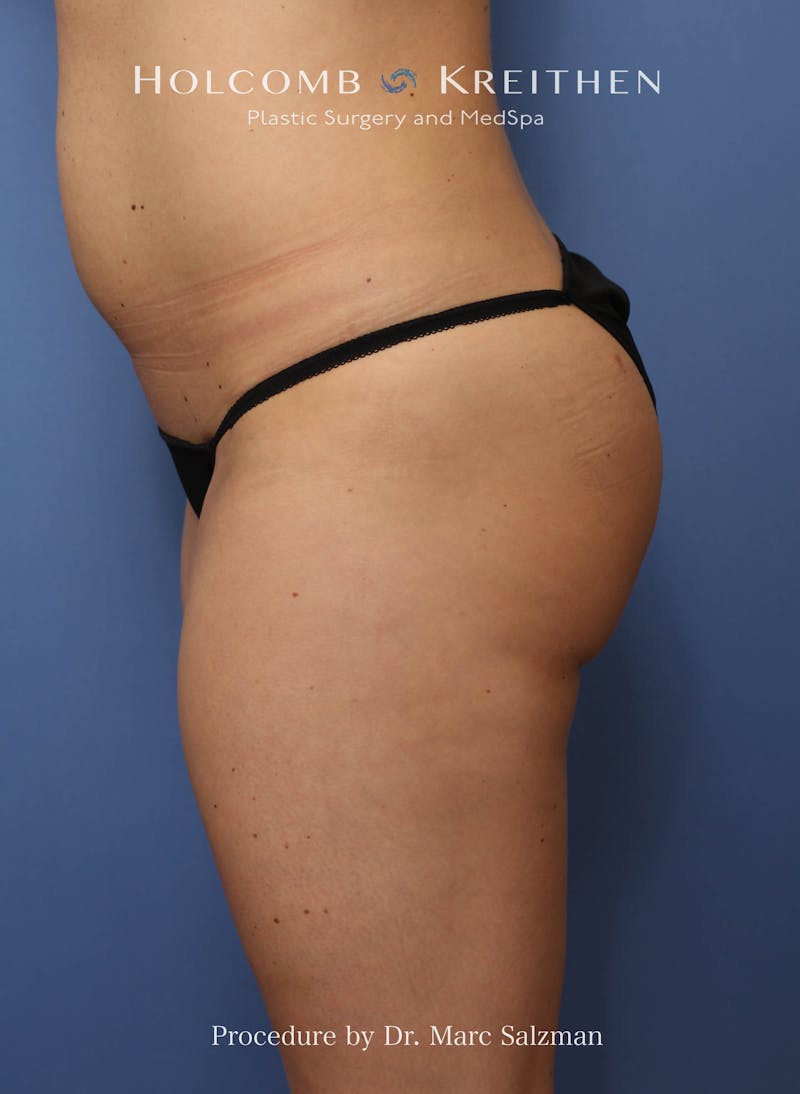 Brazilian Butt Lift Before & After Gallery - Patient 311142 - Image 6