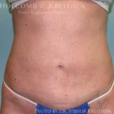 Liposuction Before & After Gallery - Patient 211866 - Image 2