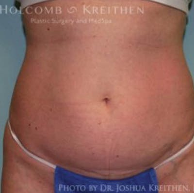 Liposuction Before & After Gallery - Patient 211866 - Image 1