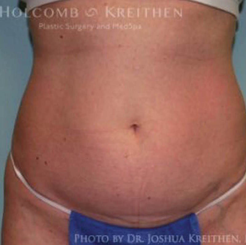 Liposuction Before & After Gallery - Patient 211866 - Image 1
