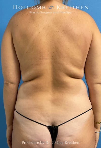 Liposuction Before & After Gallery - Patient 616458 - Image 1