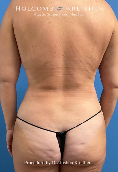 Liposuction Before & After Gallery - Patient 616458 - Image 2