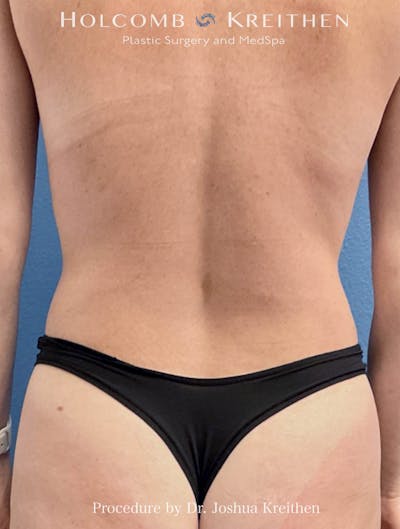 Liposuction Before & After Gallery - Patient 169999 - Image 2