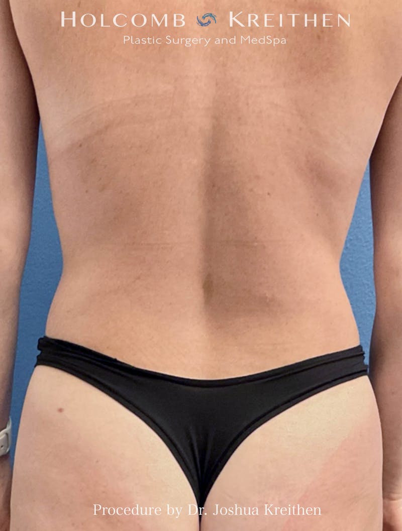 Liposuction Before & After Gallery - Patient 169999 - Image 2