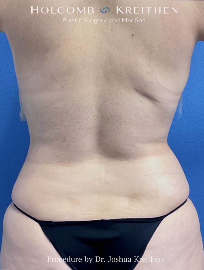 Liposuction Before & After Gallery - Patient 143941 - Image 2
