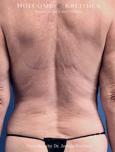 Liposuction Before & After Gallery - Patient 130504 - Image 2