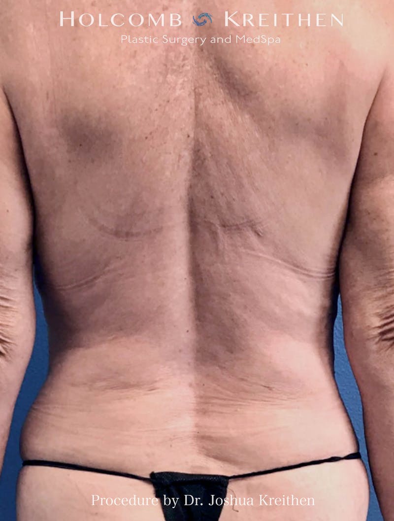 Liposuction Before & After Gallery - Patient 130504 - Image 2