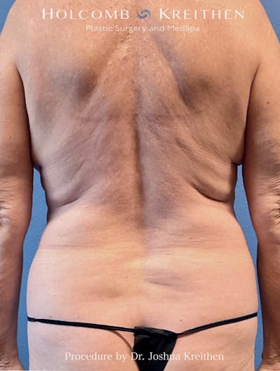 Liposuction Before & After Gallery - Patient 130504 - Image 1