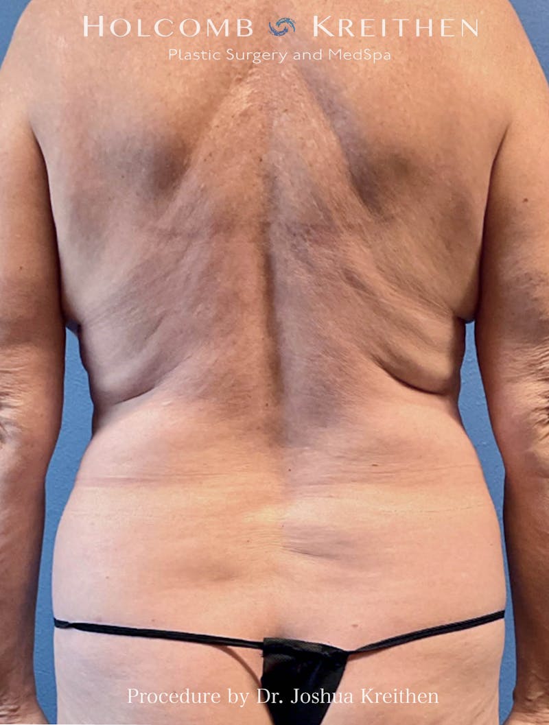 Liposuction Before & After Gallery - Patient 130504 - Image 1