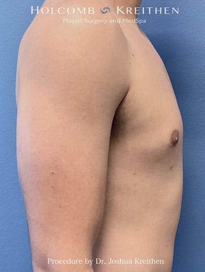 Liposuction Before & After Gallery - Patient 417612 - Image 2