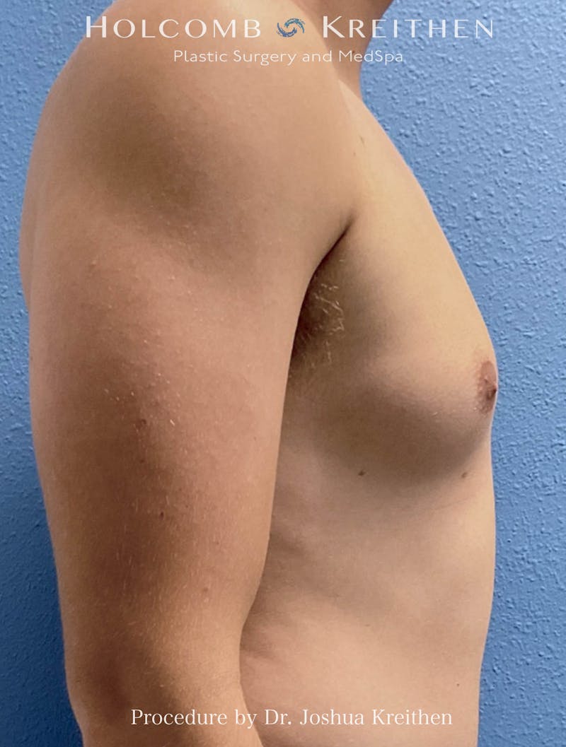 Liposuction Before & After Gallery - Patient 417612 - Image 1