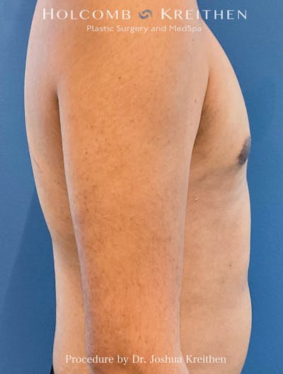 Liposuction Before & After Gallery - Patient 145543 - Image 2