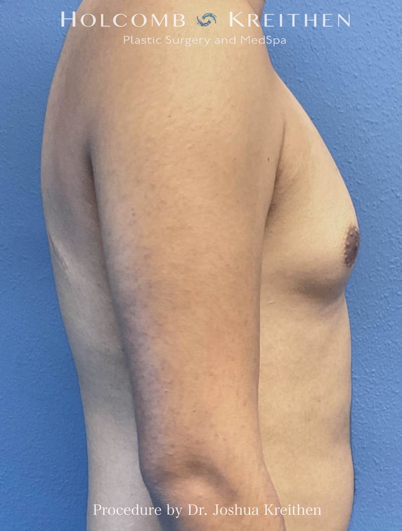 Liposuction Before & After Gallery - Patient 145543 - Image 1