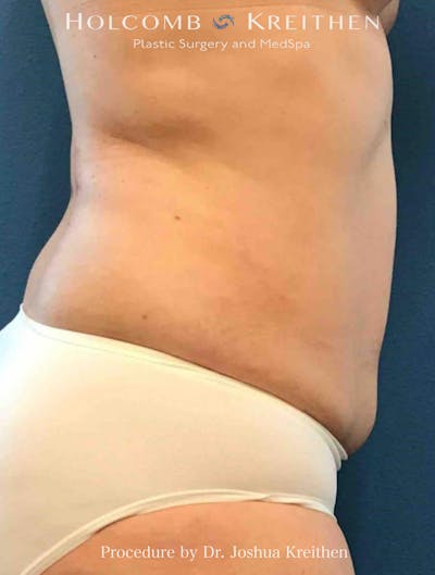 Liposuction Before & After Gallery - Patient 107918 - Image 2