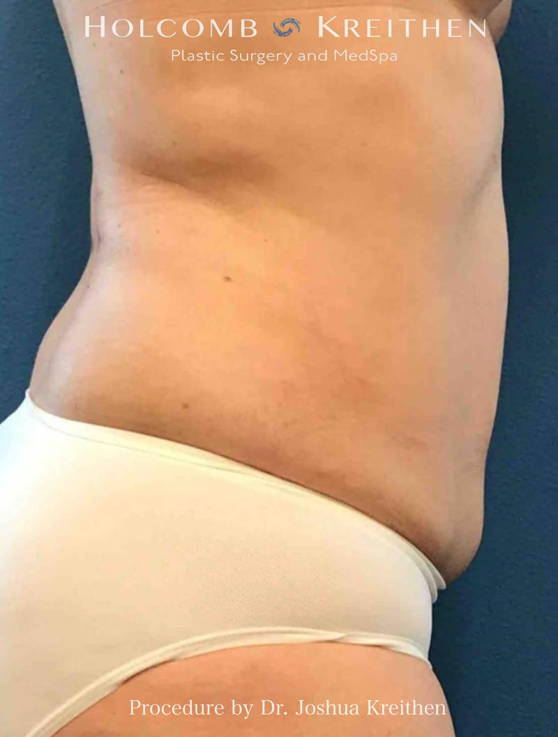 Liposuction Before & After Gallery - Patient 107918 - Image 2
