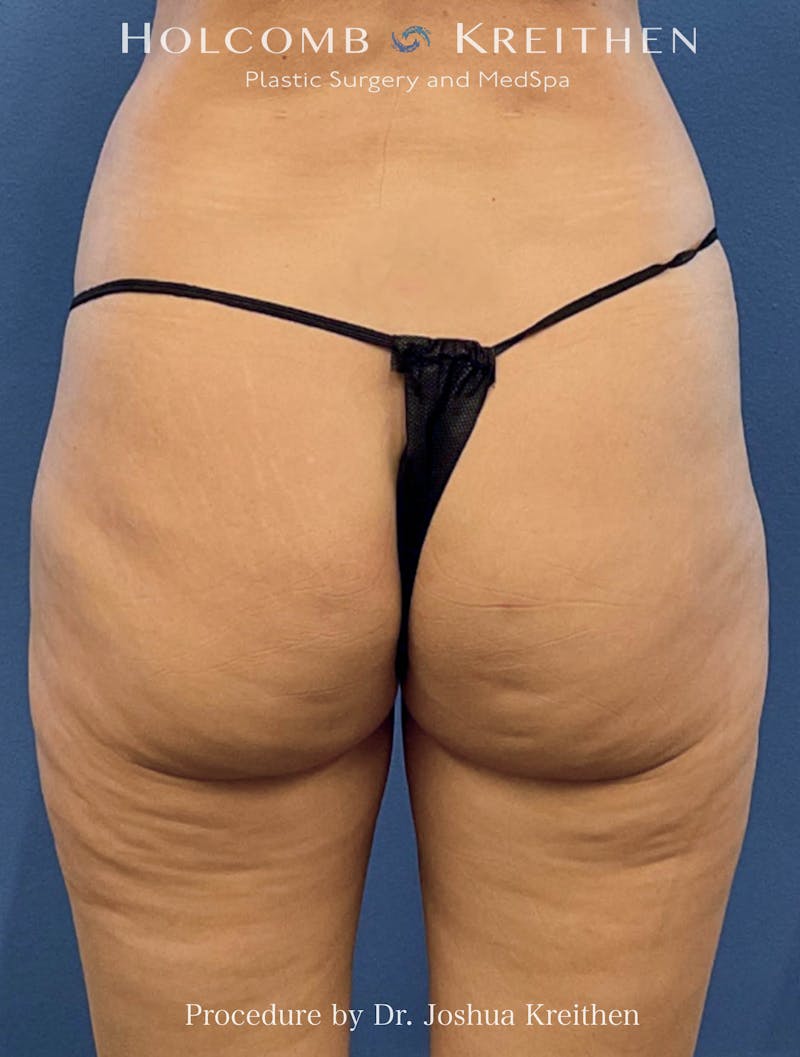 Liposuction Before & After Gallery - Patient 260840 - Image 2
