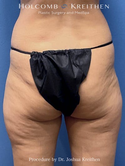 Liposuction Before & After Gallery - Patient 260840 - Image 1