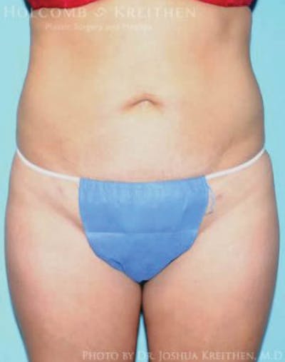 Liposuction Before & After Gallery - Patient 423563 - Image 2